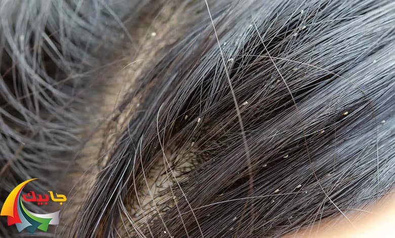 شپش سر چیست؟